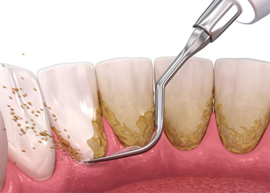 バイオフィルム